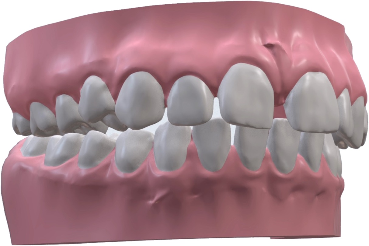 An AI-segmented 3D model from a patient scan, each tooth separated from the gingiva.